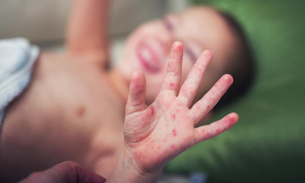 Le syndrome pieds-mains-bouche - Réalités Pédiatriques