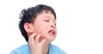 Actualité de l’anaphylaxie chez l’enfant et l’adolescent