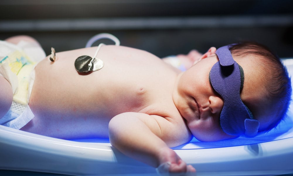 Une Phototherapie En Periode Neonatale Expose T Elle A Un Risque Ulterieur De Convulsion Realites Pediatriques