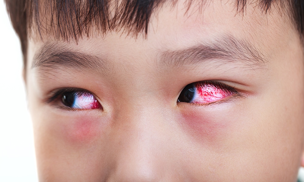 Le pédiatre face à l'œil rouge - Réalités Pédiatriques