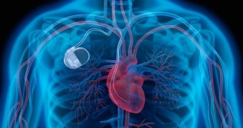 L’initiation d’un traitement par statines dès l’enfance réduit-elle le risque cardiovasculaire à l’âge adulte des patients présentant une hypercholestérolémie familiale ?