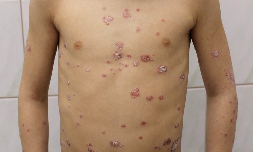 Psoriasis de l'enfant : quelle prise en charge ? - Réalités ...