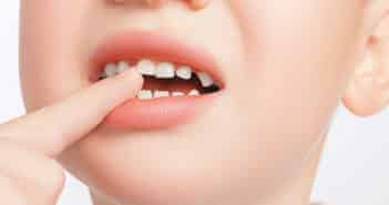 Traumatismes des dents temporaires : quand l’avis du chirurgien-dentiste est-il nécessaire ?