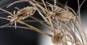 Pédiculose : quoi de neuf ?