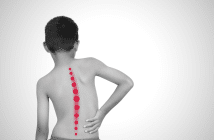 La scoliose idiopathique de l’adolescent