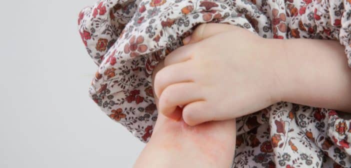Urticaire de l'enfant