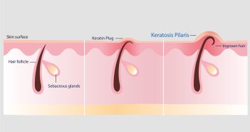 Kératose pilaire de l’enfant : que faire ?
