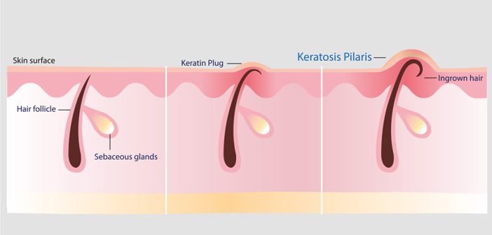 Kératose pilaire de l’enfant : que faire ?
